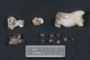 kidney_stones